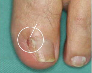 爪 横 痛い 足 親指